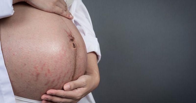 Perbedaan Stretch Mark Merah dan Putih pada Ibu Hamil